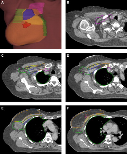 Figure 3. Representative examples of CTVs from the consensus delineation. The full CT atlas is available online (http://www.dbcg.dk : Retningslinjer/Vejledninger). CTV- breast: orange, Tumour bed: red, CTV axillary level I: bright green, CTV axillary level II: blue, CTV axillary level III: orange, CTV interpectoral LN: yellow, CTV IMN: forest green, CTV periclavicular LN: pink, Ipsilateral lung: green.