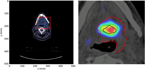 Figure 1. Patient CT scan used for this study. All subsequent images presented in the results section show the section marked by the (red) box in the left figure. Here, the PTV and GTV are outlined with blue and green lines, respectively. The black structure in the center marks the HTV. Right figure shows details of the FAZA scan and the delineated HTV (black line). The larger structure (red) again marks the GTV. GTV, gross target volume; HTV, hypoxic target volume; PTV, planning target volume.