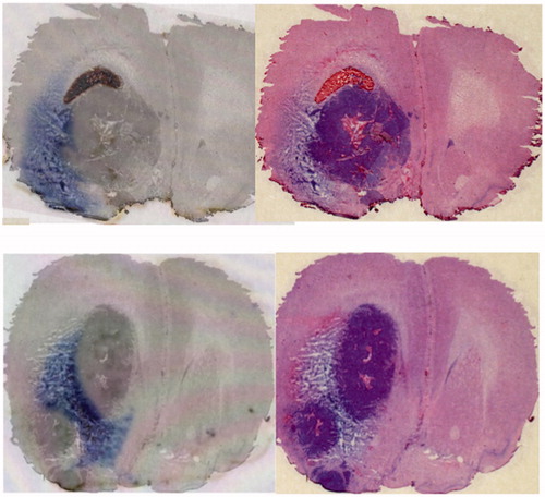 Figure 2. In the F98 glioma intracranial isografted model, trypan blue dye was infused peri-tumorally by CED. Results from 2 representative rats are shown (upper and lower). Distribution of Trypan-blue dye (left) and H&E staining of the same section (right). The dye effectively distributed into the tumor surrounding brain at the tumor-brain interface.
