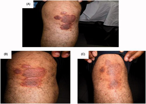 Figure 3. Assessment of the left knee psoriatic lesion treated with MTX microemulsion formulation only along the treatment course for patient 2: (A) before treatment, (B) after 3 weeks of treatment and (C) after 8 weeks of treatment.