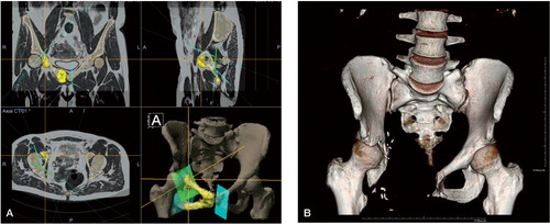 Figure 4. A. (left panel). Surgical planning of the resection planes in the Orthomap oncology module with coloration of the tumor on the fused MRI/CT image. Patient information has been digitally edited out in the bottom-left panel. The bottom-right panel shows a 3D rendering of the pelvic bone and the resection planes. Two-thirds of the acetabulum could be saved. The patient was disease-free at the 5-year follow-up, functions well, and has resumed work. B. (right panel). 3D AP volume rendering of the 3.5-year follow-up CT.