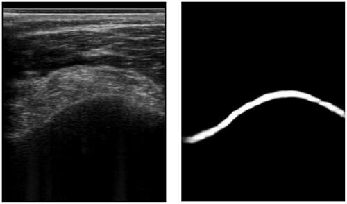 Figure 3. An example of an ultrasound image and its respective segmentation by a DeepLabv3 CNN architecture.
