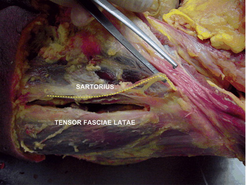 Figure 3. The course of the lateral femoral cutaneous nerve (yellow dotted line) is shown in relation to the interval between the sartorius muscle and TFL muscle in the MIS anterior and the MIS 2-incision approaches.