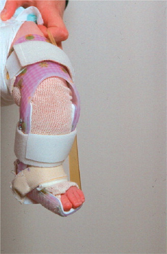 Figure 3. The dynamic Knee Ankle Foot Orthosis (KAFO, with permission from Scandinavian Orthopaedic Technical Laboratory).