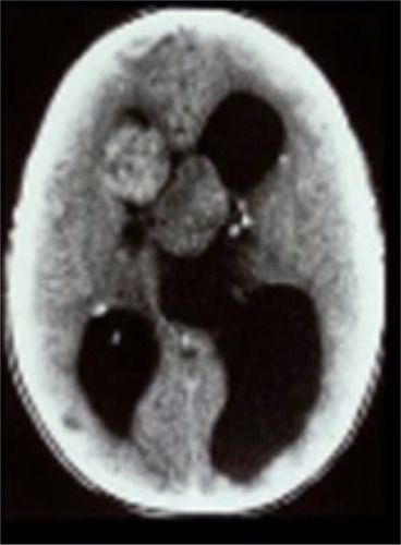 Figure 1 Computed tomography scan demonstrating acute presentation of bilateral subependymal giant cell astrocytomas with marked obstructive hydrocephalus. After emergency surgical resection, the patient with tuberous sclerosis complex was left blind and mentally retarded.