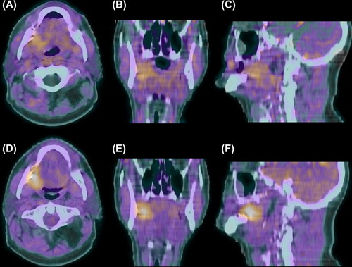 Figure 1. 18F-FMISO PET-CT scan of a cT4N0M0 oral cavity tumor 30 min after injection with diffuse uptake in tumor and normal tissues (A–C) and 3 hours after injection with specific tumor retention (D–F). Transversal (A + D), coronal (B + E) and sagittal (C + F) planes.