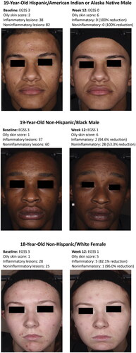 Figure 4. Improvements with tazarotene 0.045% lotion in participants with oily skin. The oily skin score is derived from the Acne-Specific Quality of Life questionnaire item 19: low/not oily (score = 5–6); moderately oily (score = 3–4); oily (score = 0–2; see Figure 1). A greater oily skin score indicates reductions in skin oiliness. Individual results may vary. EGSS: Evaluator’s Global Severity Score.