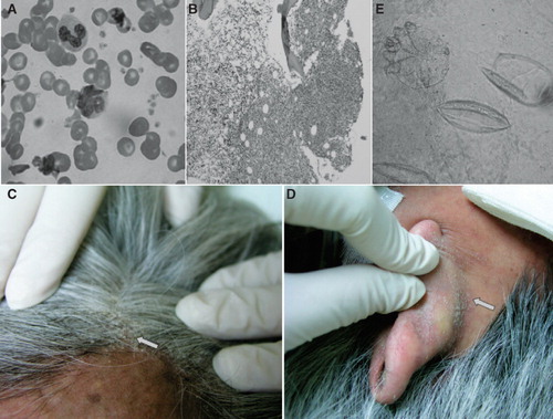 Figure 1. A: A flower-like nucleated T cell in the peripheral blood smear from the patient. B: Pathology of marrow biopsy revealed lymphomatous involvement in marrow space. C, D: Crusted scaly lesions at the scalp and posterior auricular skin fold (arrow). E: Microscopic examination of a scraping scale shows two hatched eggs (right) and a mite (left) (KOH, ×400).