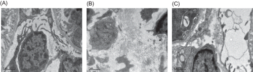 Figure 5. Electron microscopy of rat renal interstitium at week 21 (×11,500). (A) The normal ultrastructure of renal interstitium was seen in the control group. (B) A significant amount of fasciculation of collagen fibers at the affected interstitium was found in the model group. (C) Less fasciculations of collagen fibers at the affected interstitium were observed in Cozaar group.
