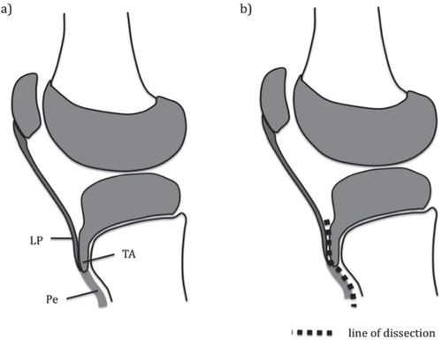 Figure 3. a. Sagittal-plane view of the proximal tibia (deep incision) indicating the relation of the patellar tendon insertion and the anterior tongue of the physis. Note that the physis remains untouched. LP: ligamentum patellae; TA: anterior tongue of the physis; Pe; periosteum. b. The patella tendon gets sharply dissected from the tibial tuberosity. The periosteum is then split along the tibial crest and detached distally by rasp. This leads to a spontaneous slide of the patella tendon medially.