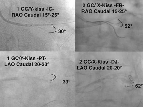 Figure 6. X versus Y-kiss at the wires level: 1 Guiding Catheter versus 2 Guiding Catheters in LAO and RAO caudal views. Y-kiss wires views are extracted from records of previous single access TRA cases of distal LMCA PCI.