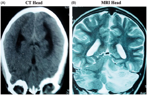 Figure 3. (A) Non-contrast CT head at presentation showing diffuse white matter and gray matter edema. (B) MRI brain of the same patient showing hyperintense lesions in parietooccipital area and cerebellar regions predominantly on the left side on T2W images.