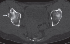Figure 2. Sagittal plane CT scan image optimized for bone density, showing the “os acetabuli” (arrow).