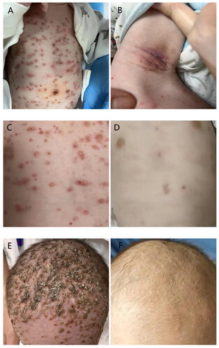 Figure 1. Skin lesions including truncus, axilla, and scalp(A,B,C,E)before treatment. After two weeks of treatment, the truncus and scalp lesions basically subsided (D,F).