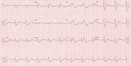 Fig. 4.  A 12-lead ECG showing junctional rhythm and BEP with QRS 0.126 s after 200 mEq NaHCO3 in ICU.