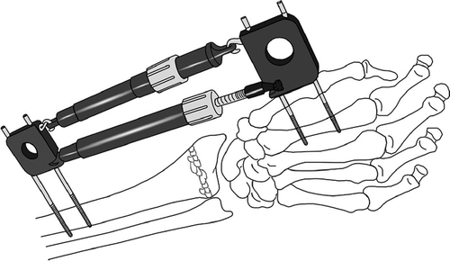 Figure 2. The Dynawrist external fixator.