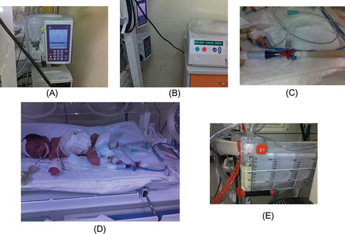 Figure 1.  Set-up for PD treatment of an infant who needed a dwell volume of less than 60 mL. (A) Infusion pump; (B) PD fluid bag and PD machine for heating purposes; (C) three-way router; (D) patient; and (E) urine-collecting device for measurement of drained volume of PD fluid.