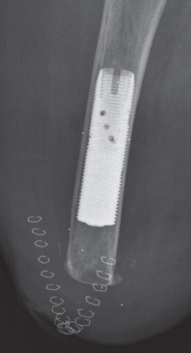 Figure 1. Implant after stage-2 (S1) surgery with tantalum RSA beads.
