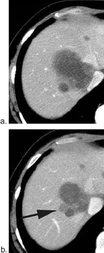 Figure 6. Possible cause for inconsistency; “new lesion”. A 50-year-old patient with multiple liver metastases at the baseline study (a). After seven cycles of treatment, a low-attenuation lesion was depicted adjacent to the known metastases (arrow in b). Reader A interpreted this lesion as a “new lesion” indicating progressive disease (PD) regardless decrease size of other metastases, while reader B interpreted this lesion existed at baseline and classified as partial response (PR).