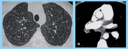 Figure 3. High-resolution computed tomography of the chest in pulmonary veno-occlusive disease.(A) High-resolution computed tomography of the chest showing marked ground-glass opacities with centrilobular pattern, ground-glass opacities with poorly defined nodular opacities, septal lines. (B) High-resolution computed tomography of the chest showing mediastinal lymph node enlargement.