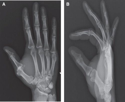 Figure 1. Anteroposterior (A) and lateral (B) view radiographs taken at time of injury demonstrate volar thumb metacarpophalangeal joint dislocation.