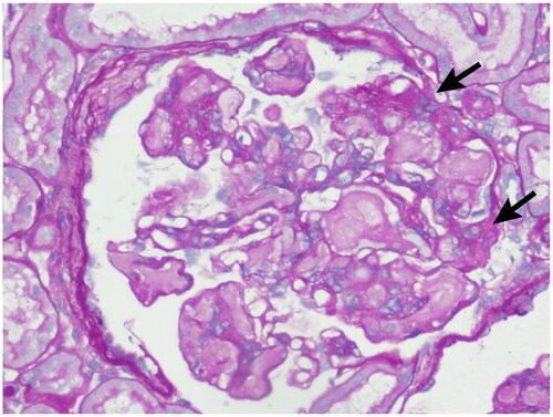 Figure 5. Light microscopy: Proliferation of mesangial cells and matrix was observed in the renal specimen.