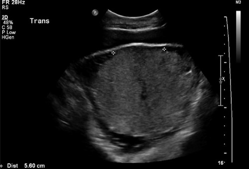 Figure 1 Deficiency of retroplacental sonolucent zone.