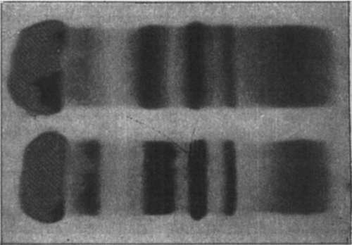 Figure 2.  Agar-gel electrophoresis of serum from patient 4 (above) and a healthy subject (below). Both belong to haptoglobin group 2-2.