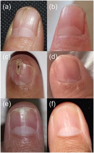Figure 2. Comparison between pre- and post- PDL irradiation in three typical cases. (a) Case 1, female, 56 years, right thumb, longitudinal erythronychia. (b) Case 1, five years after two sessions of PDL irradiation. (c) Case 2, female, 35 years, left index finger, longitudinal erythronychia with distal fissuring and splinter hemorrhages. (d) Case 2, three years after one session of PDL irradiation. (e) Case 3, female, 24 years, left thumb, longitudinal leukonychia with onycholysis and V-shaped distal notch. (f) Case 3, one year after five sessions of PDL irradiation.