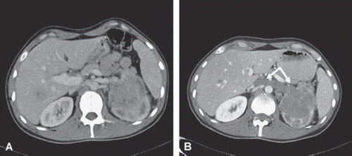 Figure 2. CT scan of the primary tumour of the second patient at baseline (A) and after two cycles of sunitinib demonstrating a newly formed thrombus in the caval vein (arrows) (B).