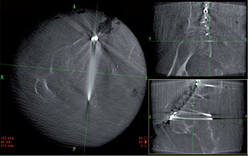 Figure 2. The intraoperative 2D reconstructed views of a posterior column lag screw visualized in a 2-column fracture. The axial reconstruction is shown to the left, coronal view is shown to the upper right, and sagittal view is shown to the lower right. The surgeon can orientate the planes parallel to the screw, enabling a precise evaluation of the screw path and confirming the extra-articular position in the cytoloid fossa.