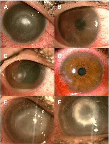 Figure 1 Ocular findings at presentation: Ring infiltrates ((A), 20 eyes), perineural infiltrates ((B), 29 eyes), hypopyon ((C), 7 eyes), scleritis ((D), 3 eyes), diffuse stromal infiltrates ((E), 26 eyes). After amniotic membrane grafting (F).