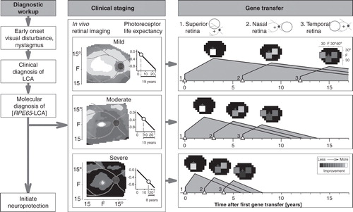 Figure 4. An algorithm for gene therapy in RPE65-LCA. Diagnostic workup is followed by clinical staging for severity of retinal degeneration. Photoreceptor life expectancy from time of initial mapping can then be calculated using the delayed exponential model of the disease. Simple or more complex strategies can then proceed with targeting of specific regions of retina proven to have photoreceptor integrity. Neuroprotection can be initiated as early as the diagnosis is made. See text for more details.
