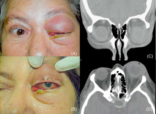 Figure 1. Clinical picture showing eyelid edema, proptosis (A); conjunctival hyperemia and corneal infiltrate (B); coronal (C); and axial (D) computed tomography illustrating proptosis and diffuse orbital infiltrate.