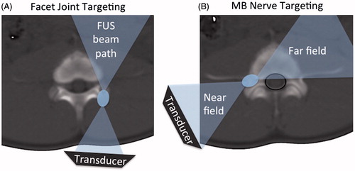 Figure 1. (A) Schematic of facet joint FUS ablation, showing the FUS beam (blue) aimed at the surface of the facet joint, and the far field of the beam aimed away from the spinal cord. (B) Schematic of the proposed FUS ablation approach with direct targeting of the medial branch (MB) nerve and far field area and spinal canal (black line) partially overlapping.
