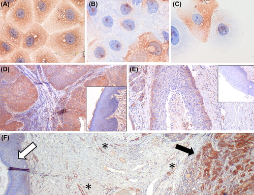 Figure 2. FLT1 is overexpressed in human HNSCC. (A–C) The specificity of the FLT1 staining (shown in brown) was examined by immunocytology of formalin-fixed FLT1 silenced SQD9 cells: (A) non-silencing control treated cells (400×); (B, C) FLT1-silenced cells. FLT1 positive cells in the FLT1-silenced conditions are expected since siRNA delivery is not equally effective in all cells. These positive cells prove that the FLT1 staining was performed correctly. (400×) (D–F) Immunohistochemistry on resected HNSCC. (D, E) show images of HNSCC samples with FLT1 expression (brown) in the full epithelial thickness, or expression limited to the basal layers respectively (40×). Corresponding normal epithelia are shown as insets (100×). (F) Immunohistochemistry of a HNSCC resection specimen showing FLT1 expression in the tumour (black arrow) but none in the normal epithelium (white arrow). Blood vessels used as an internal positive control for FLT1 staining are marked by ‘*’ (40×).