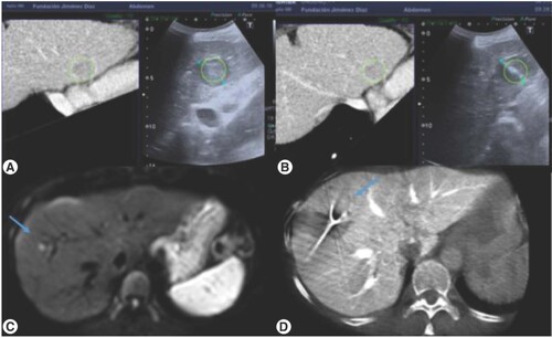 Figure 2. Alternative imaging guidance when ultrasound visibility was limited. (A & B) Ultrasound CT fusion allowed a real-time synchronization of a recent imaging test where the target was clearly identified with the intraoperative ultrasound (C & D) Expert CT used for the approach of the lesion as well as for the final check of the procedure.