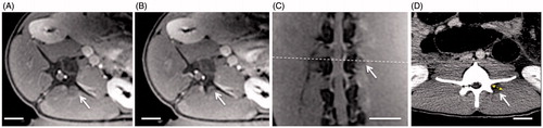 Figure 4. Follow-up contrast-enhanced cropped MR and CT images from subacute experiment 1, showing the changes in contrast uptake from ablation of the vertebral level target at L4 using nine sonications. Location of the axial slice (A) is shown with a white dashed line on the oblique coronal image (C), and the axial slice shown in (B) is positioned adjacent and caudal to the slice in A. Thermal lesions appear as non-enhancing areas (white arrows) due to the lack of perfusion resulting from thermal damage. The dashed double-sided arrow in D shows the measurement of the extent of the lesion along the hypotenuse between the transverse and articular processes as reported in Table 1. The solid double-sided arrow shows the measurement of the thickness of the pedicle bone. Scale bar is 2 cm.