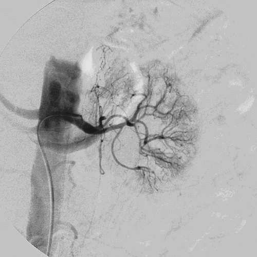 Figure 2. DSA of the same patient that demonstrates normal patency of the left renal artery.