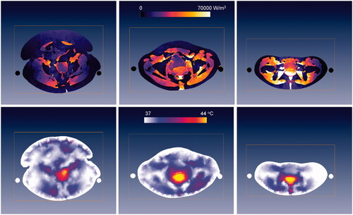 Figure 3. Cross-sections of the PD for 400 W (upper row) and temperature distributions (lower row) predicted by Sigma-HyperPlan for a large (left), average (middle) and slim (right) patient with a cervical tumour (red contour). Visible are also the slings on which the patient is positioned during deep HT (black or white circles on each side of the patient). The temperature distributions are obtained by increasing power until 44 °C in healthy tissue is reached.