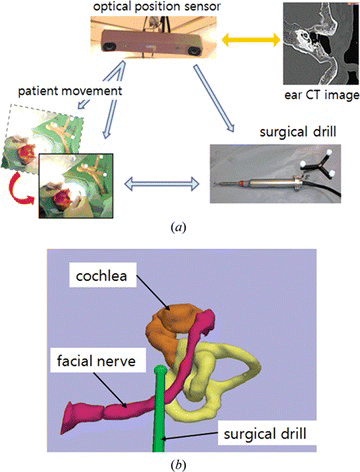 Figure 4 The surgical navigation; (a) configuration of image guidance for surgery, (b) display of surgical navigation for ear surgery (color figure available online).