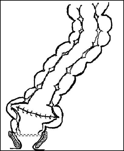Figure 2.  The coloplasty.