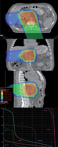 Figure 1. Typical optimized proton plans later in our series utilized a posterior or posterior-oblique field delivering approximately 75% of the prescribed dose in conjunction with a right lateral or lateral oblique field delivering the remaining 25%. As proton beams are associated with no exit dose beyond the target, significant sparing of anterior small bowel and stomach tissues could be achieved. No patient treated in this fashion experienced grade 2 or higher gastrointestinal toxicity. Based on this favorable toxicity profile, all patients with pancreatic cancer at UFPTI are treated using this field configuration.