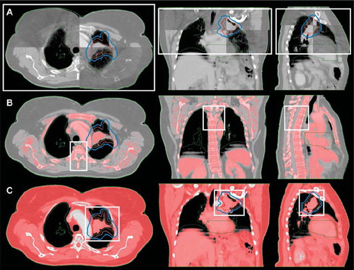 Figure 1. A user-defined 3D rectangular ROI (white box) when performing a WT (A), CV (B) and ST (C) CBCT match. (A) The cranio-caudal (CC) borders of the ROI were limited by the length of the CBCT scan. The left-right (LR), and the anterior-posterior (AP) borders were positioned just outside the thorax volume to assure whole thorax volume inclusion in the ROI. (B) The CC borders of the ROI were limited by the extent of the PTV (blue line). The LR, and the AP borders were positioned just outside the columna vertebralis when using bone window level in Offline Review. The volume within the ROI utilized for the CV match is colored red (i.e. the pixels with an intensity range of 50–3000 HU). (C) The CC borders of the ROI were limited by the extent of the PTV. The LR, and the AP borders were positioned next to the PTV. The volume within the ROI utilized for the ST match is colored red (i.e. the pixels with an intensity range of -150-150 HU) (Color version of figure is available online.)
