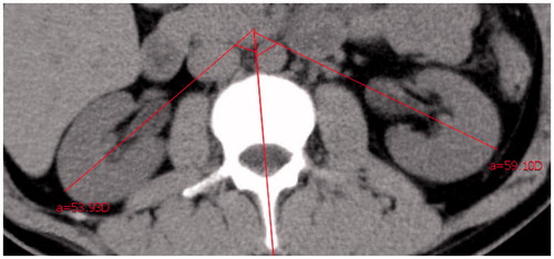 Figure 4. Measurement of the bilateral renal pelvis angle on computed tomography image.