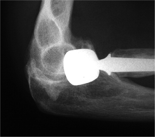 Figure 3. Lateral radiograph of case 7 showing erosion of the capitellum; approximately one-third of the capitellum has been eroded by the prosthesis. The patient had no complaints related to the erosion.