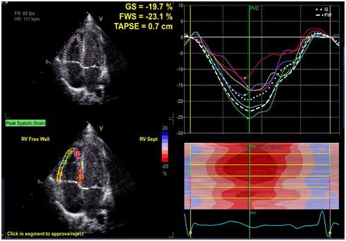 Figure 6. Right ventricular global longitudinal strain (RV GLS). The endocardial boundary of the right ventricle was automatically delineated using two-dimensional speckle tracking echocardiography on the apical 4-chamber view, with a specific focus on the RV. This included the RV apical segment, RV free wall, and RV interventricular septum to demonstrate the maximum diameter of the RV. The myocardial segments visualized by two-dimensional speckle tracking echocardiography comprised the basal, middle, and apical segments of the RV free wall, as well as the apical, middle, and basal segments of the RV interventricular septum. The RV GLS value in the figure is −19.7%.