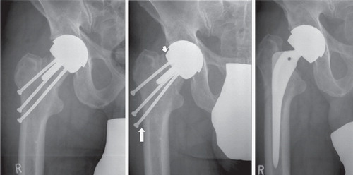 Figure 1.  A. Traumatic periprosthetic femoral neck fracture 18 weeks after the index procedure treated with cannulated cancellous screws. B. Collapse of the femoral neck (short arrow) led to marked dislocation of both the proximal femoral remnant and all 3 screws (long arrow). C. After the revision surgery with conversion to a femoral stemmed total hip replacement with extra-large femoral head.