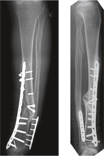 Figure 1. Frontal plane varus deformity without sagittal plane deformity of the tibia, with leg-length discrepancy of 2.2 cm in patient with tibial non-union.