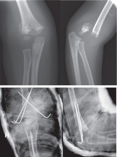 Figure 9. Gartland 3 supracondylar humerus fracture in a 3 year old girl, managed by closed reduction and percutaneous pinning.